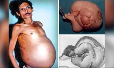 Indian man ‍‍`pregnant‍‍` with twin for 36 years
