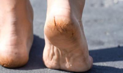 পায়ের ফাটা গোড়ালিতে মোজা যাচ্ছে জড়িয়ে; কী উপায়!