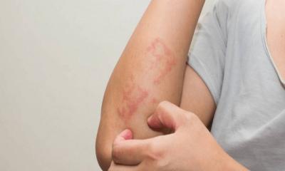 গরমে র‌্যাশ বা চুলকানি এড়াতে যা করবেন