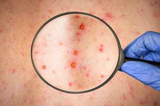 UAE detects 1st monkeypox patient