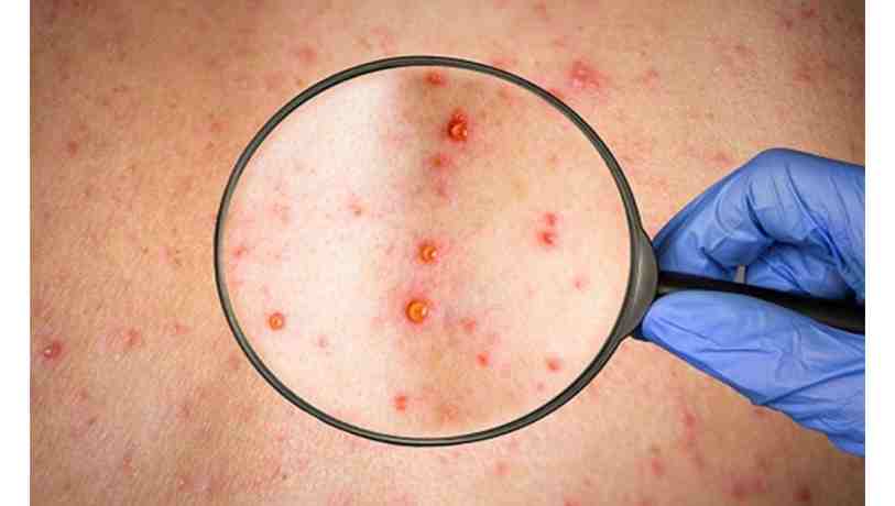 UAE detects 1st monkeypox patient