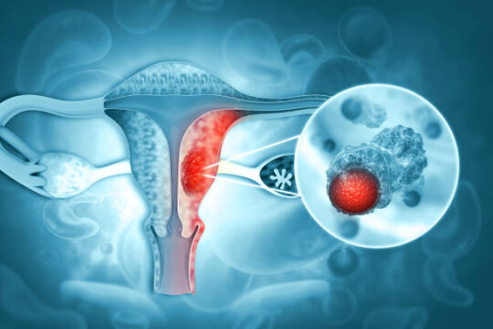 Nearly 5,000 women die of cervical cancer annually