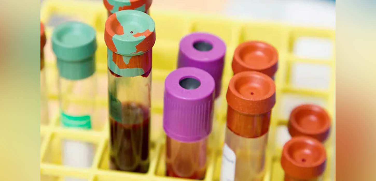 Blood type may be linked to the risk of having an early stroke, says study